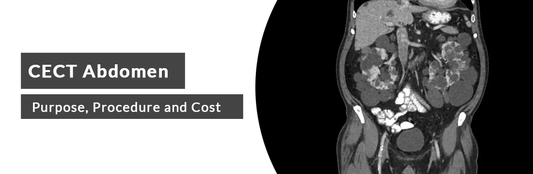 CECT Abdomen: Purpose, Procedure and Cost